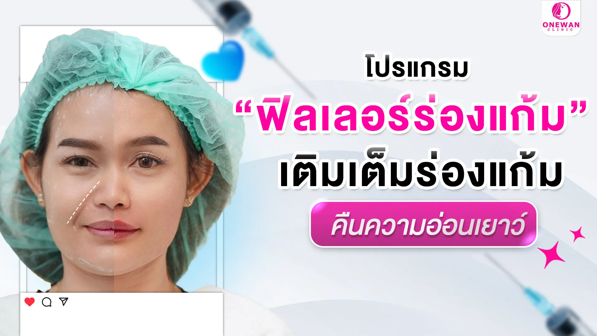 ฟิลเลอร์ร่องแก้ม