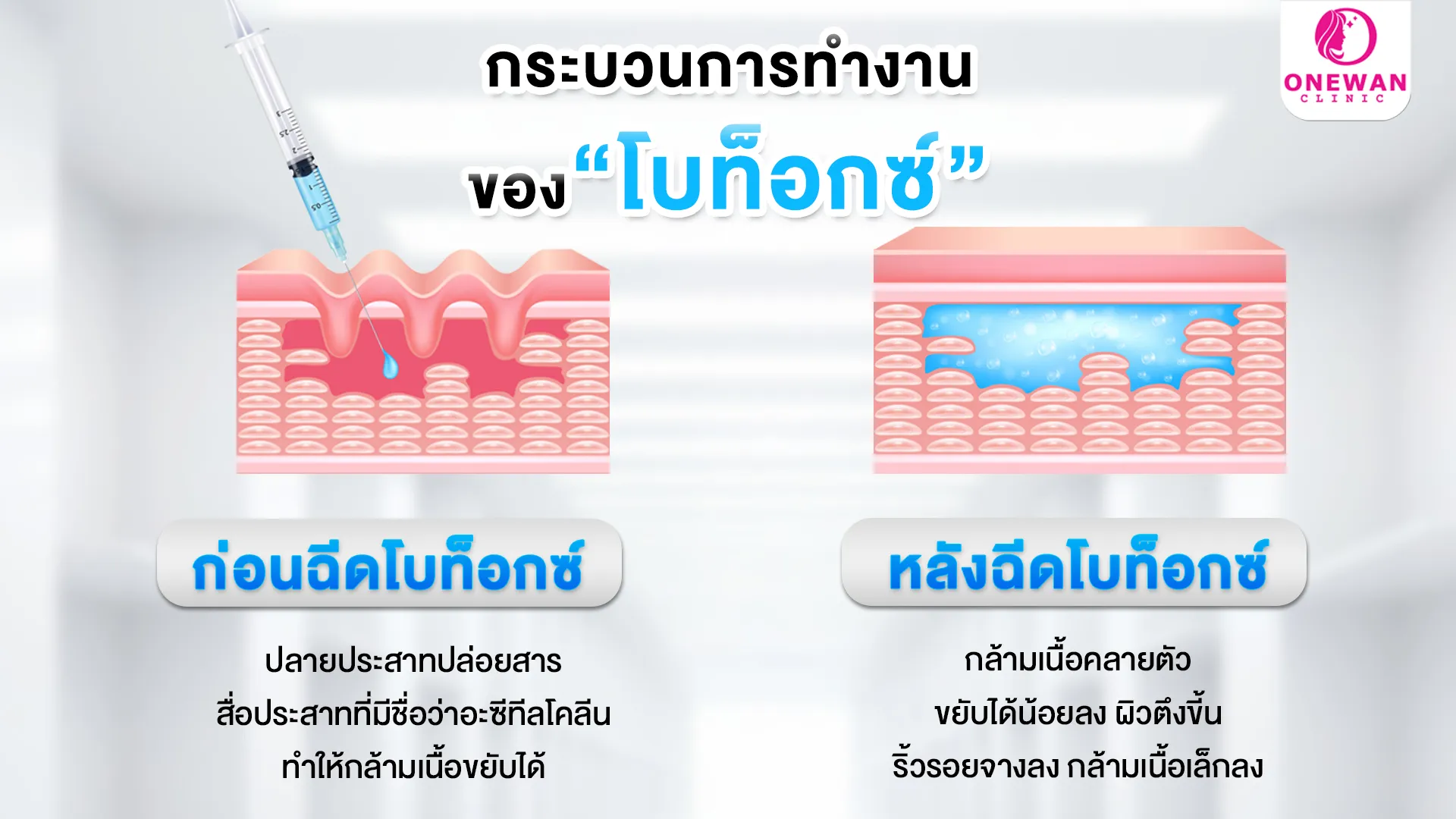 ขั้นตอนการทำงานของ โบท็อกซ์