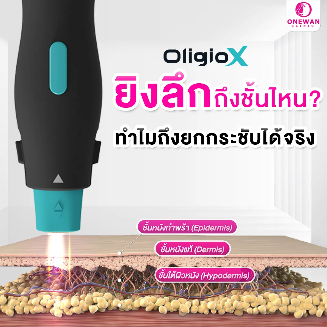 OligioX ยิงลึกถึงชั้นไหน ทำไมถึงยกกระชับได้จริง