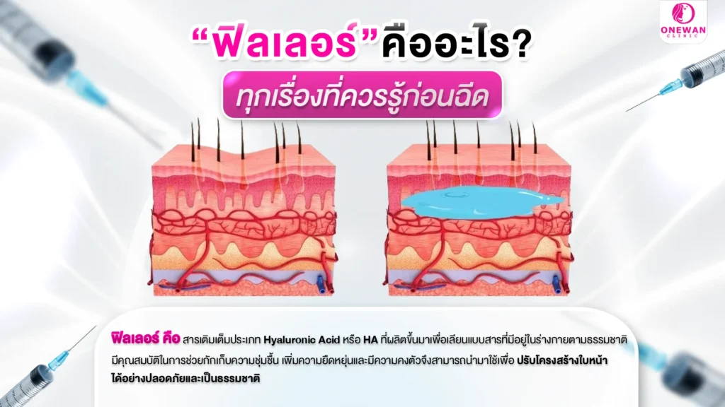 ฟิลเลอร์ คืออะไร