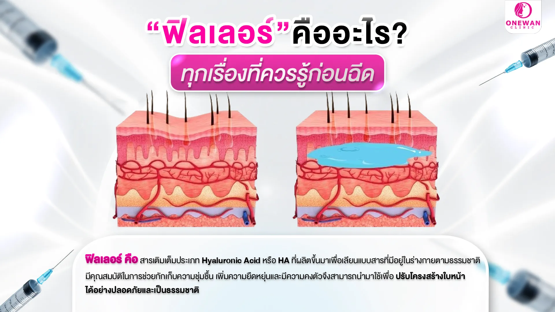 ฟิลเลอร์ คืออะไร