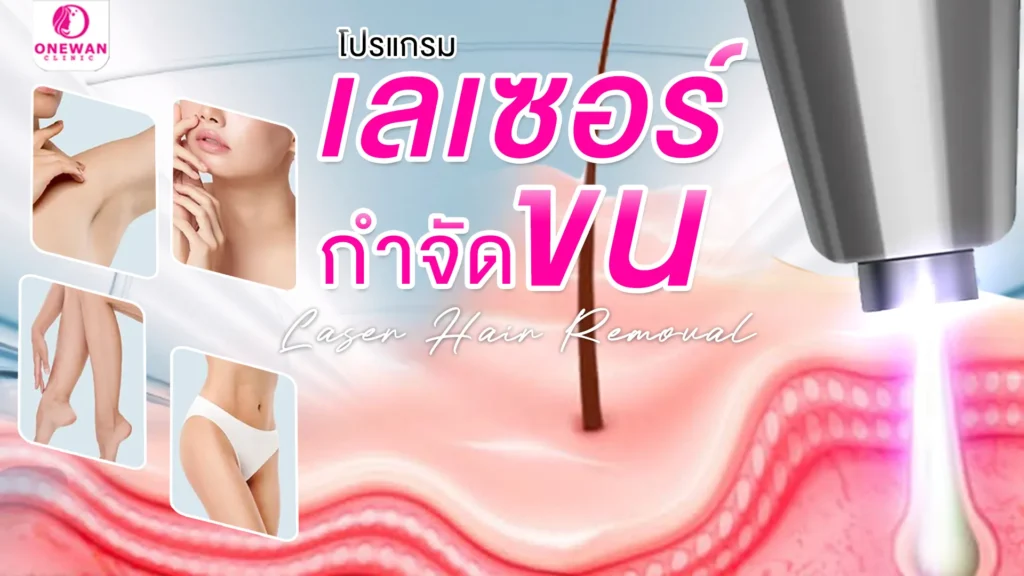 เลเซอร์กำจัดขน