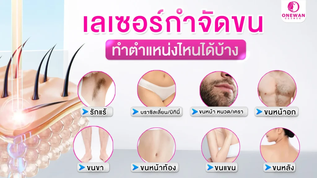 เลเซอร์กำจัดขนทำตำแหน่งไหนได้บ้าง