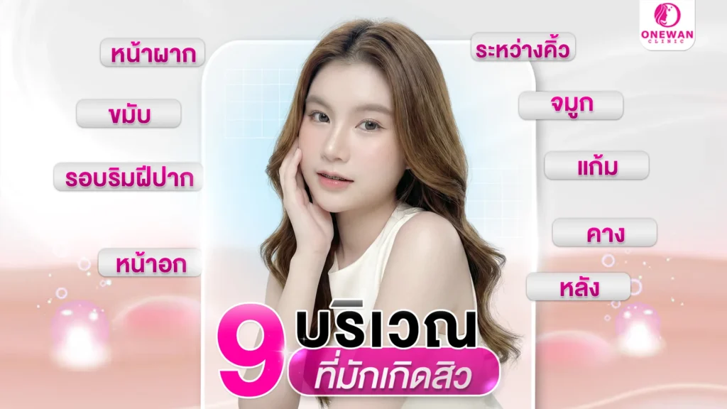 9 บริเวณที่มักเกิดสิว