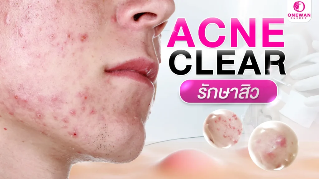 รักษาสิวบุรีรัมย์