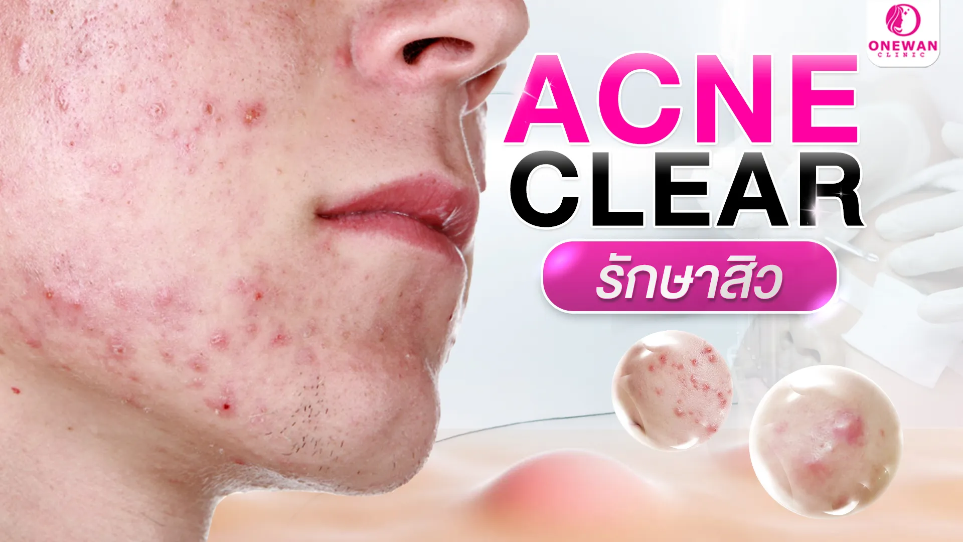 รักษาสิวบุรีรัมย์