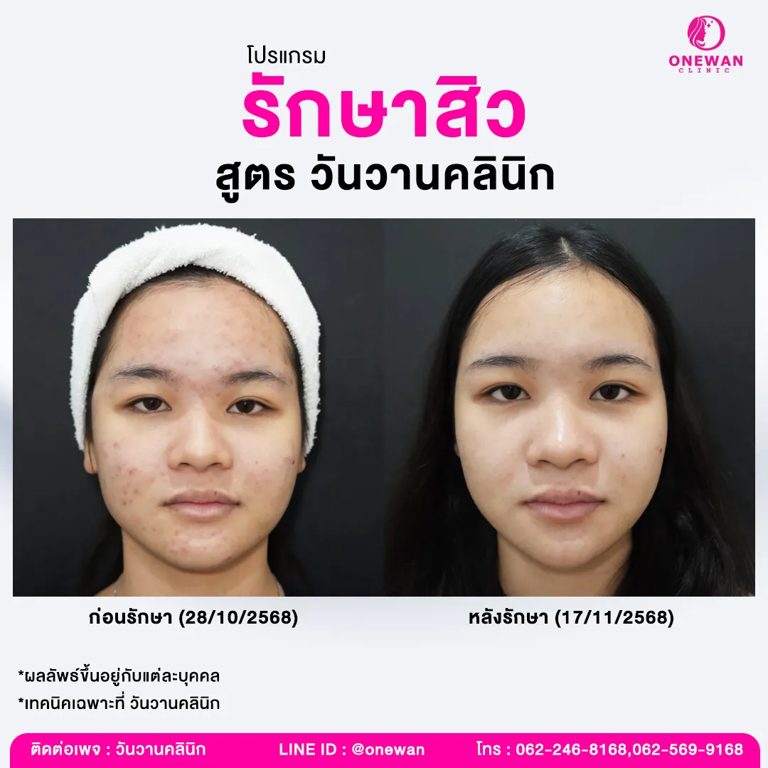 รีวิวรักษาสิว 1