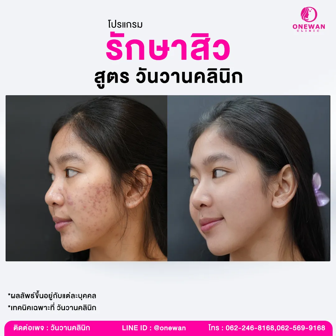 รีวิวรักษาสิว สูตรวันวาน 2