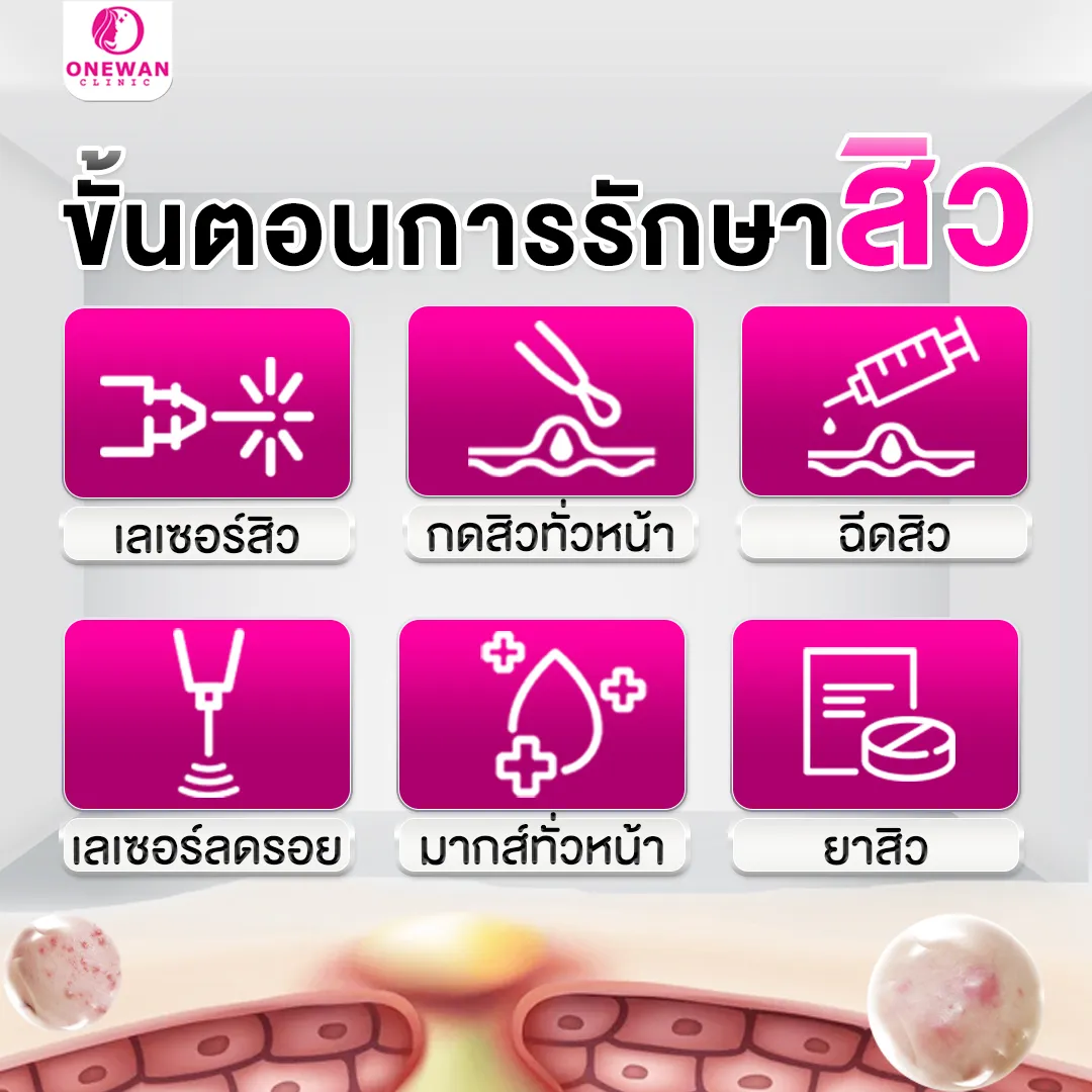 ขั้นตอนการรักษาสิว