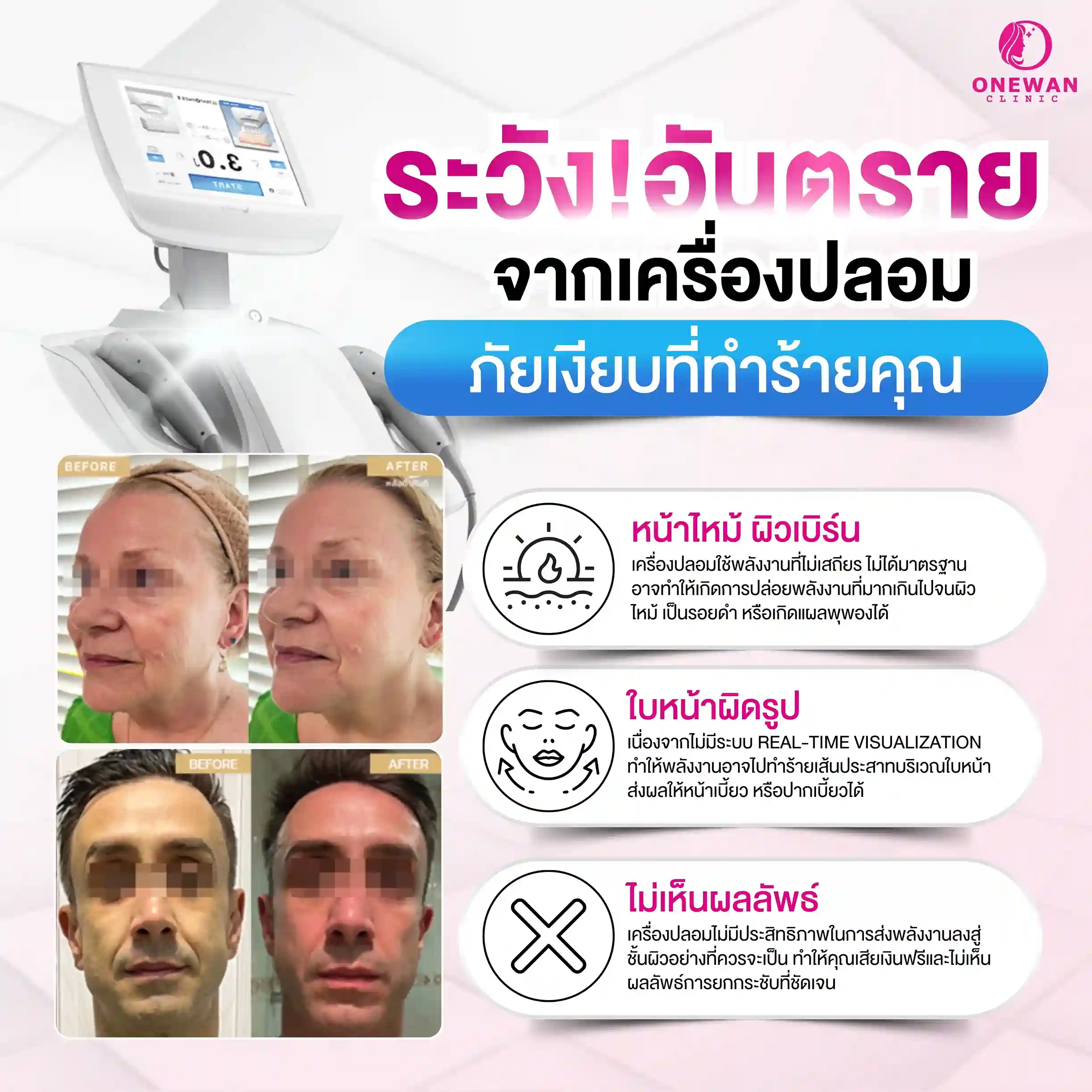 อันตรายจากเครื่องยกกระชับผิวปลอม