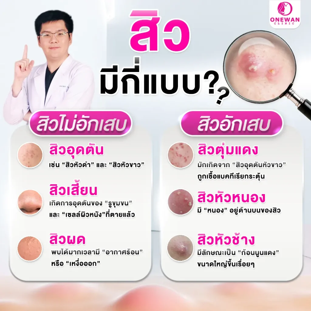 ประเภทของสิว มีกี่แบบ