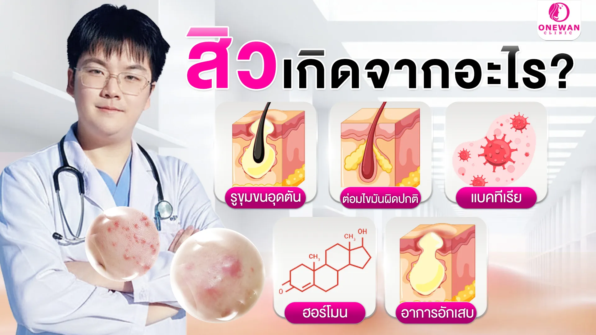 สิวเกิดจากอะไร