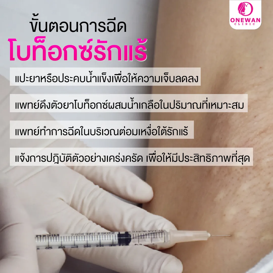 ขั้นตอนการฉีดโบท็อกรักแร้