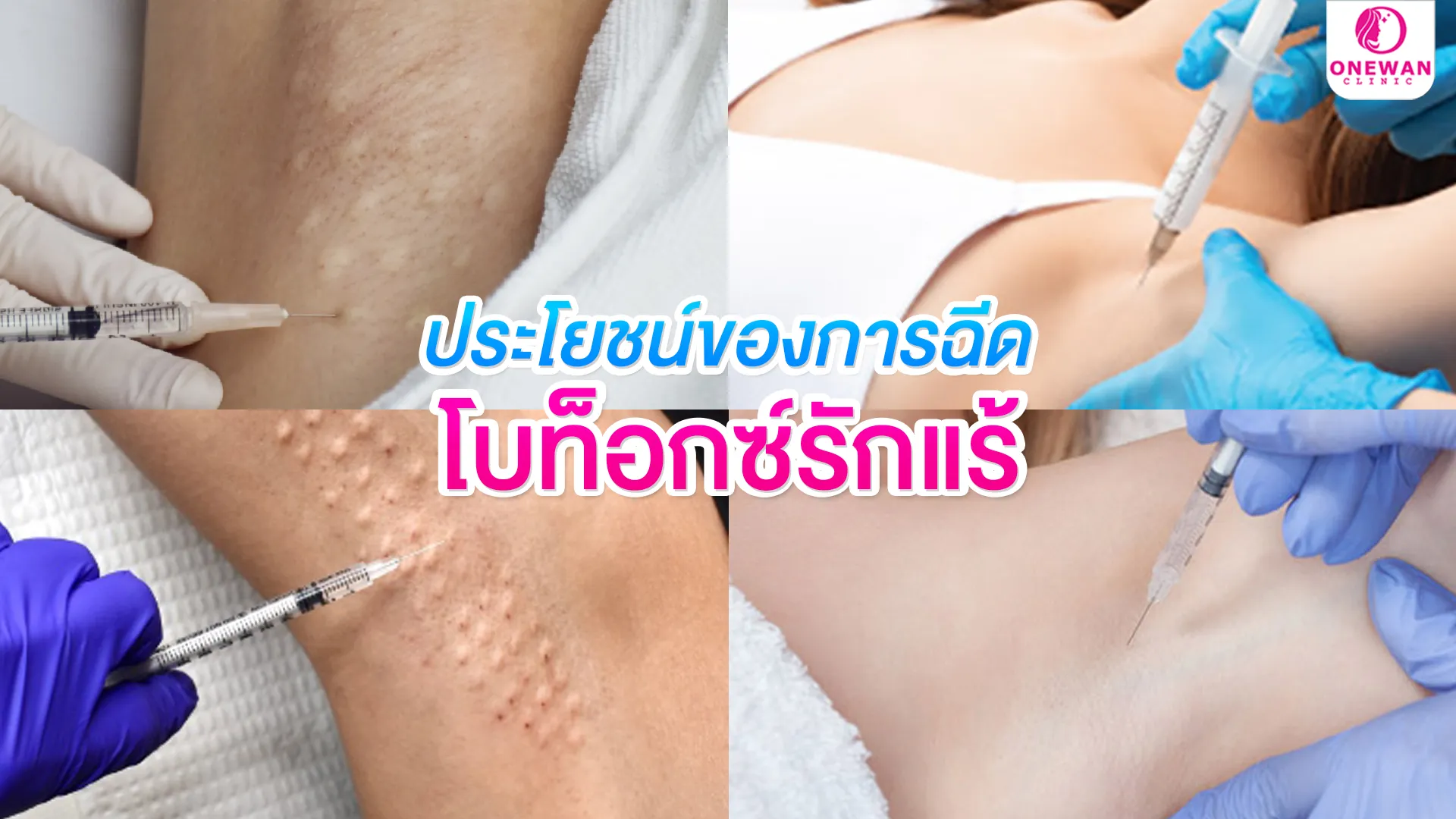 ประโยชน์ของการฉีดโบท็อกรักแร้