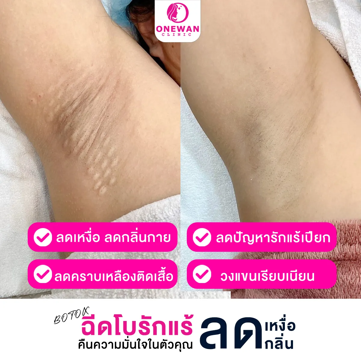 รีวิว ฉีดโบท็อกรักแร้ 1