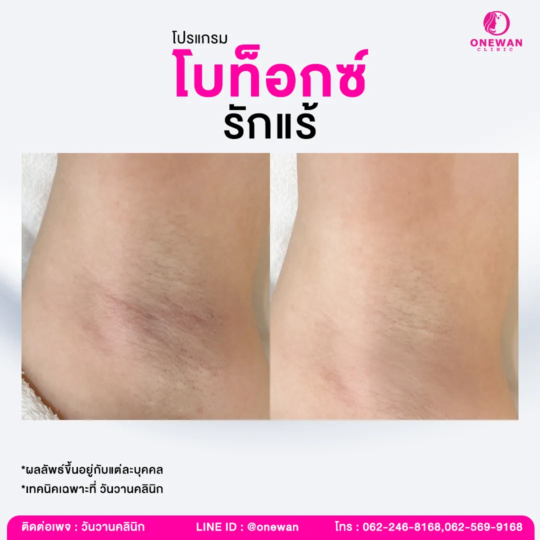 รีวิว ฉีดโบท็อกรักแร้ 2