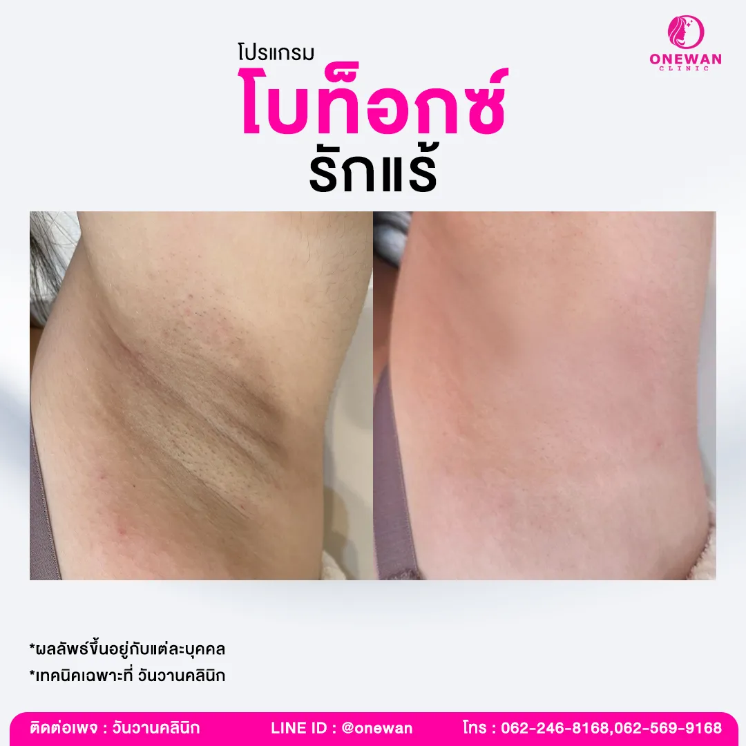 รีวิว ฉีดโบท็อกรักแร้ 3