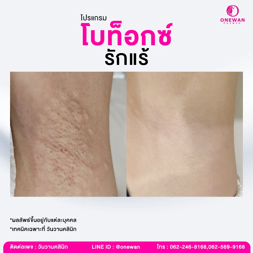 รีวิว ฉีดโบท็อกรักแร้ 4