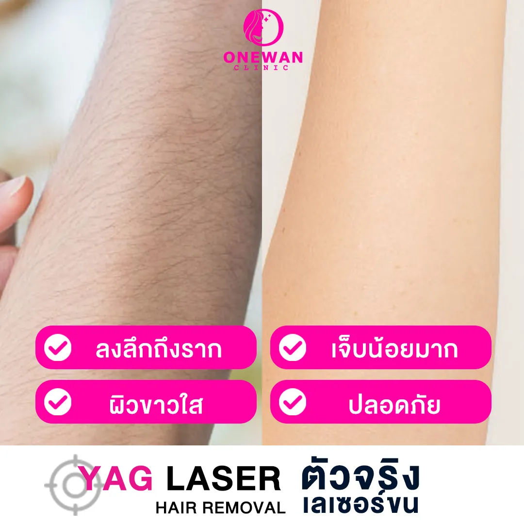 เลเซอร์ขนแขน