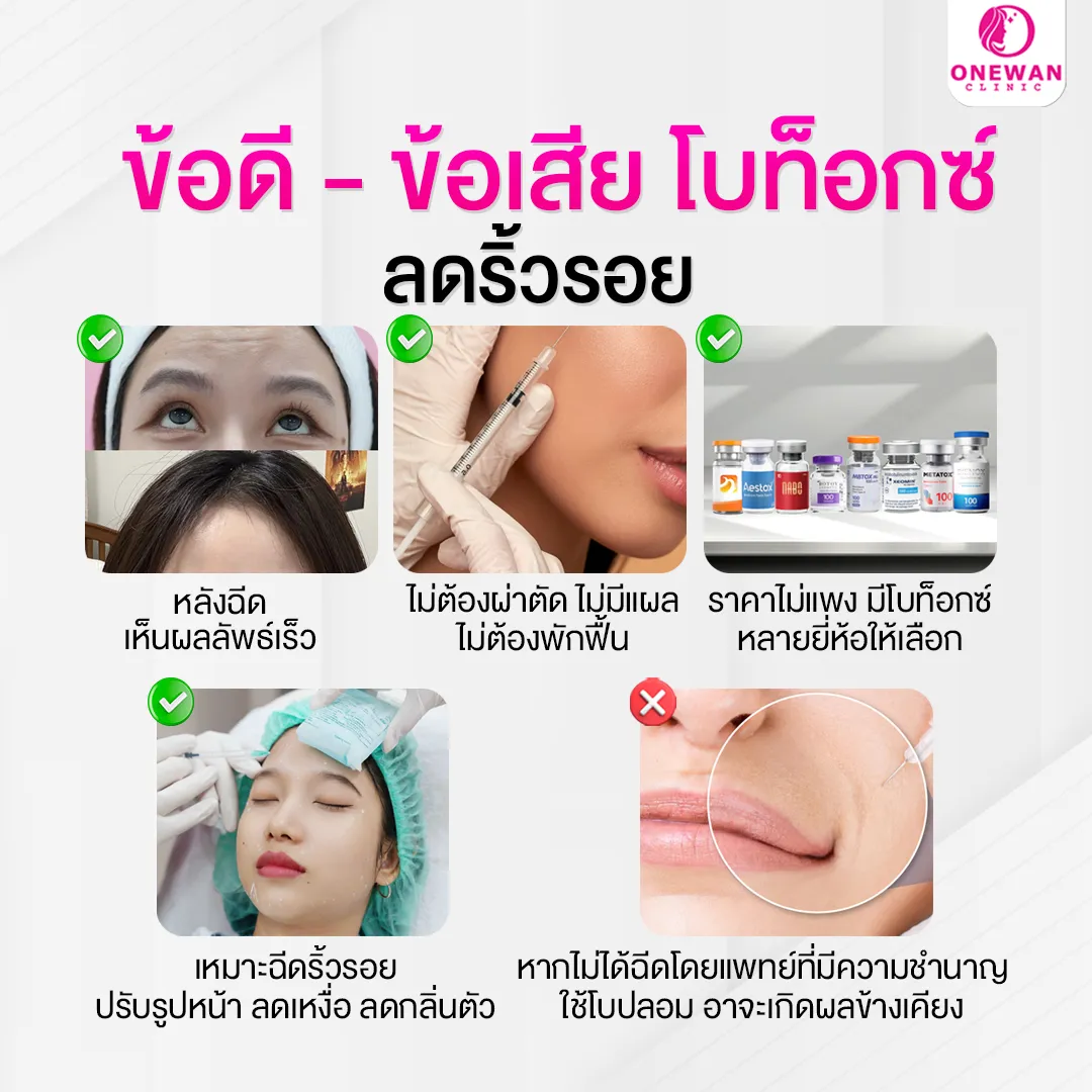 ข้อดีข้อเสียฉีดโบท็อกลดริ้วรอย