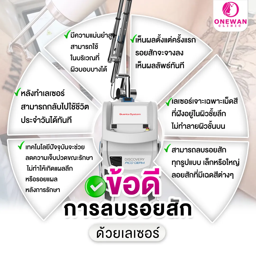 ข้อดีการลบรอยสักด้วยเลเซอร์