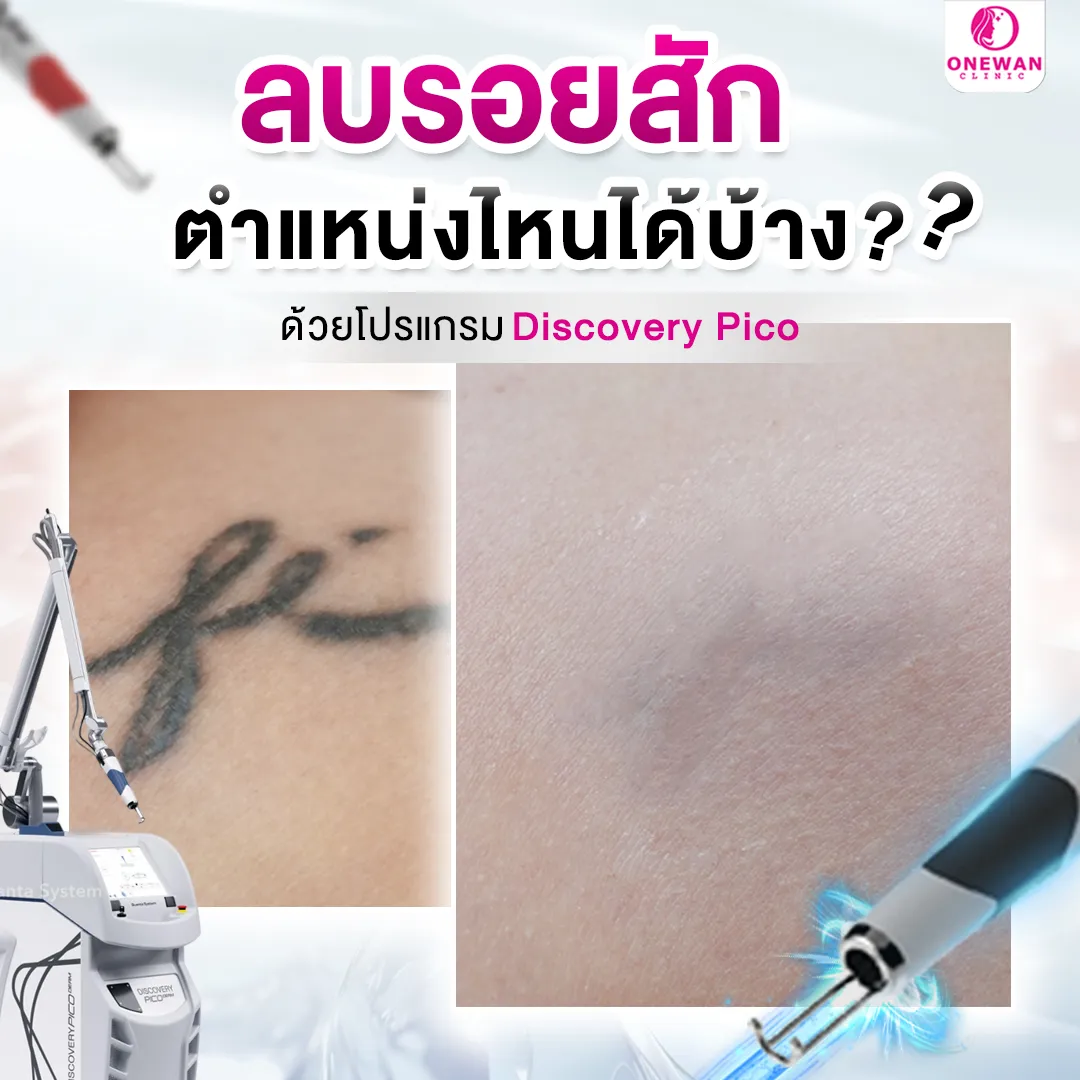 ลบรอยสัก ตำแหน่งได้บ้าง