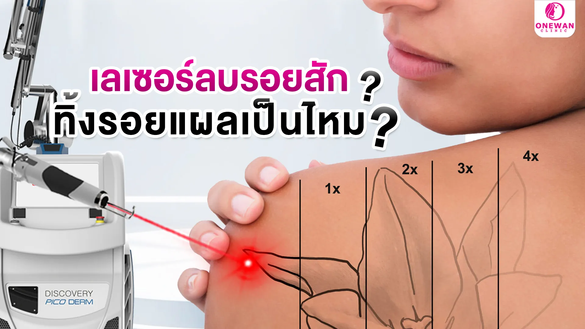 เลเซอร์ลบรอยสัก ทิ้งรอยแผลเป็นไหม