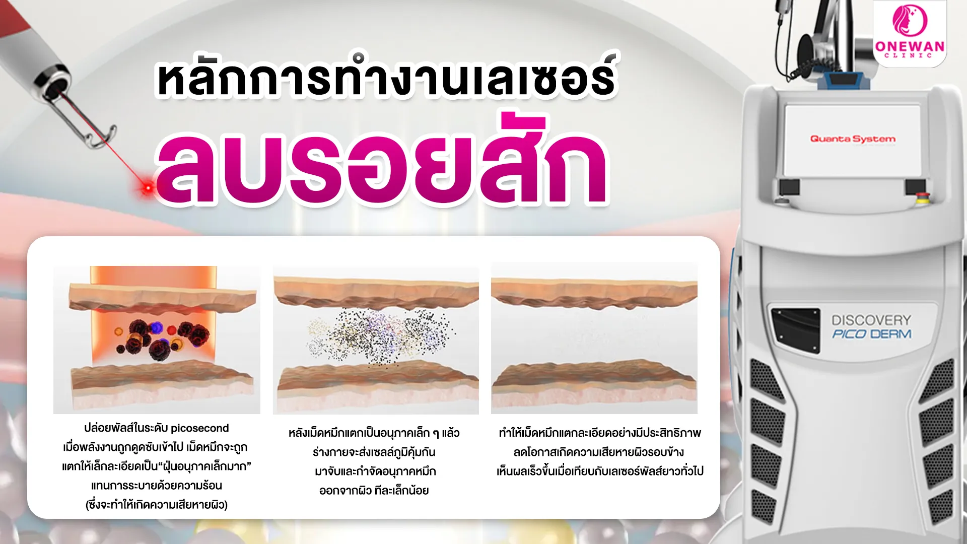 หลักการทำงานของเลเซอร์ลบรอยสัก