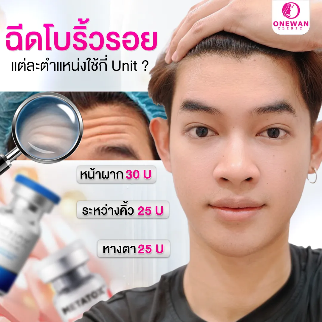 โบท็อกริ้วรอย แต่ละจุดใช้กี่ยูนิต