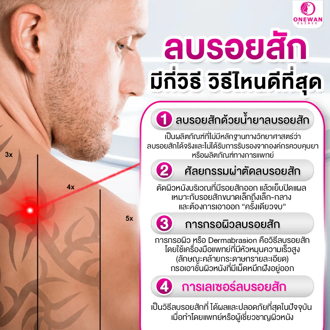 ลบรอยสัก มีกี่วิธี แล้ววิธีไหนดีที่สุด