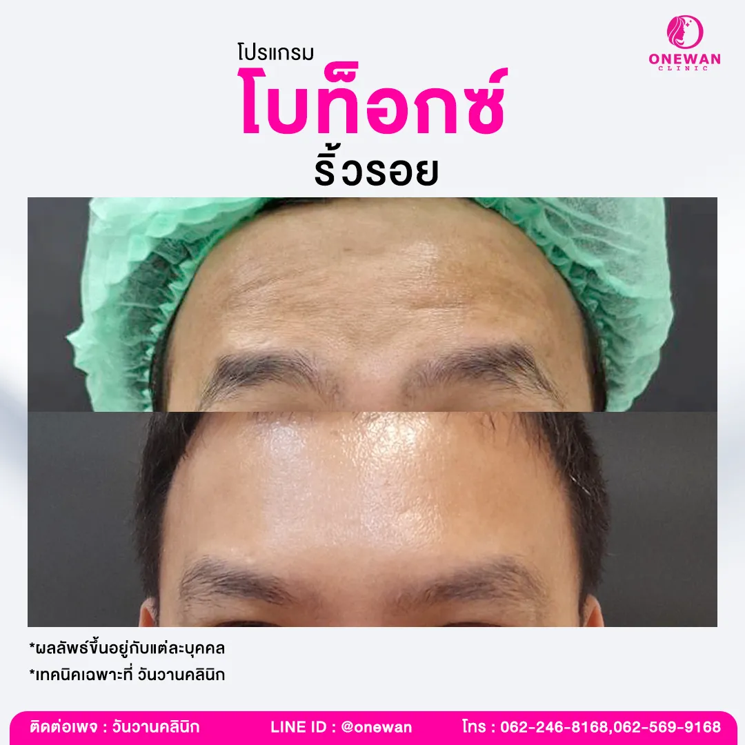 รีวิวโบท็อกซ์ลดริ้วรอย 2