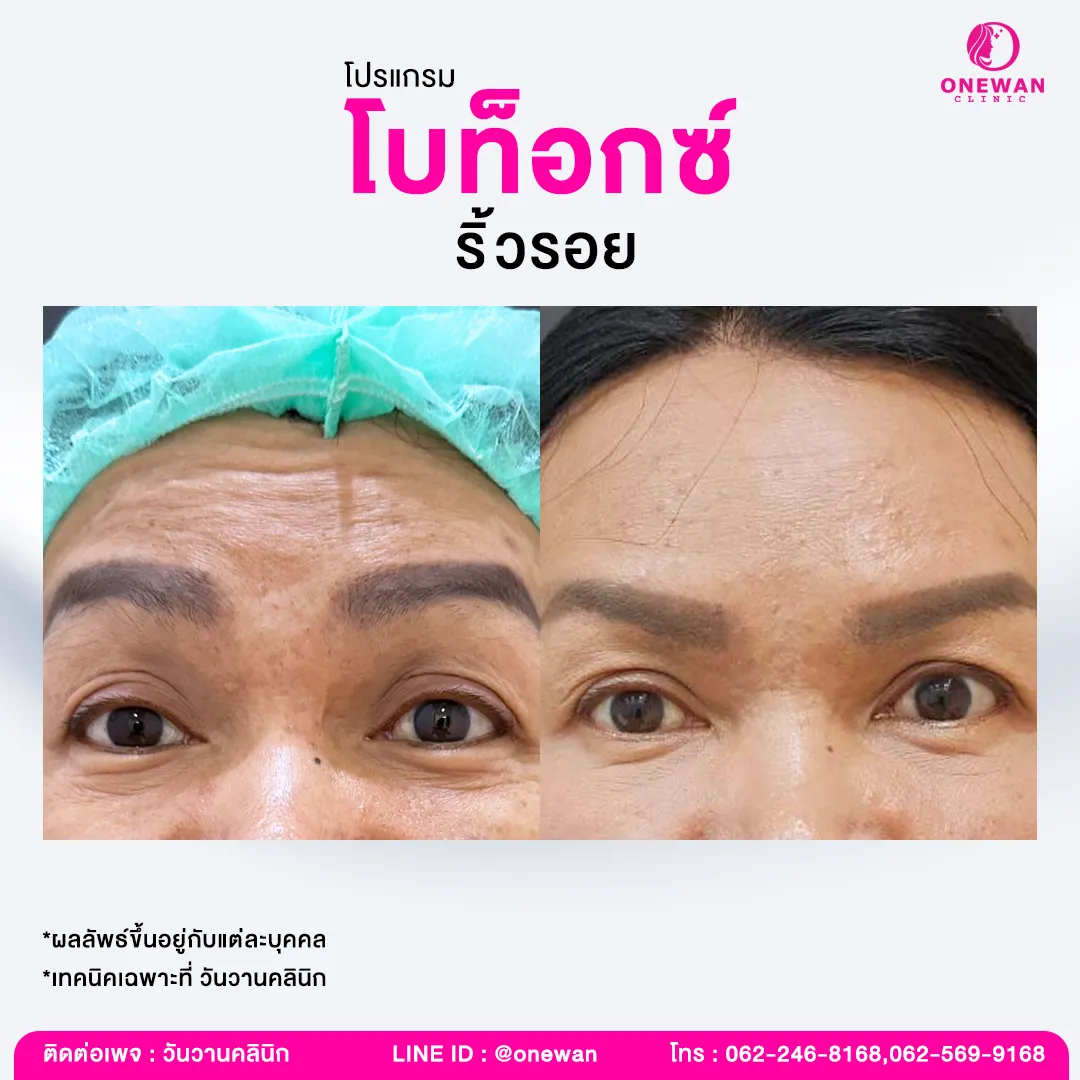 รีวิวโบท็อกซ์ลดริ้วรอย 4