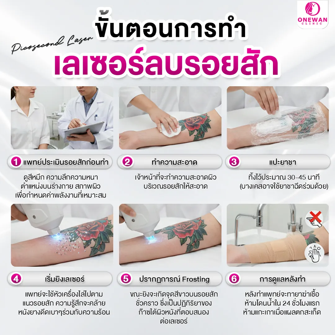 ขั้นตอนการลบรอยสักด้วย Picosecond Laser