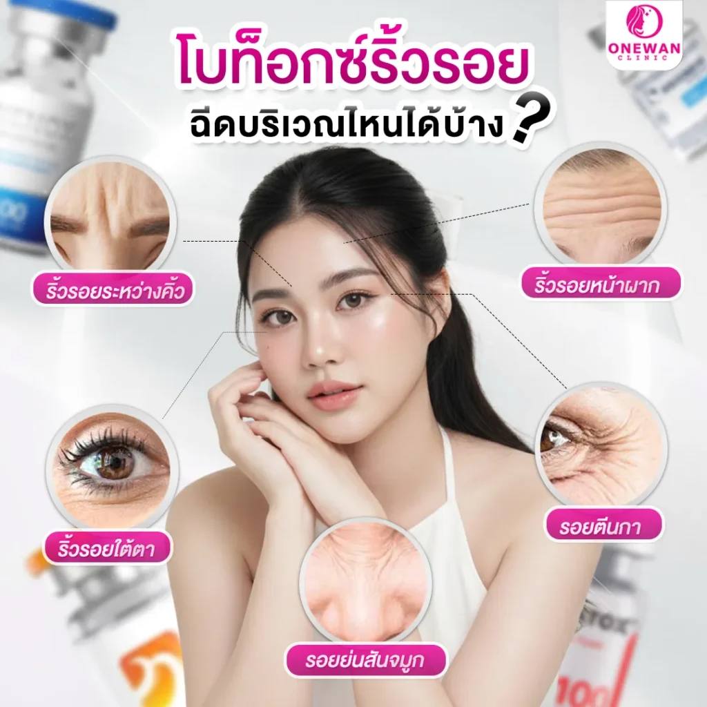 ฉีดโบท็อกลดริ้วรอย จุดไหนได้บ้าง ?
