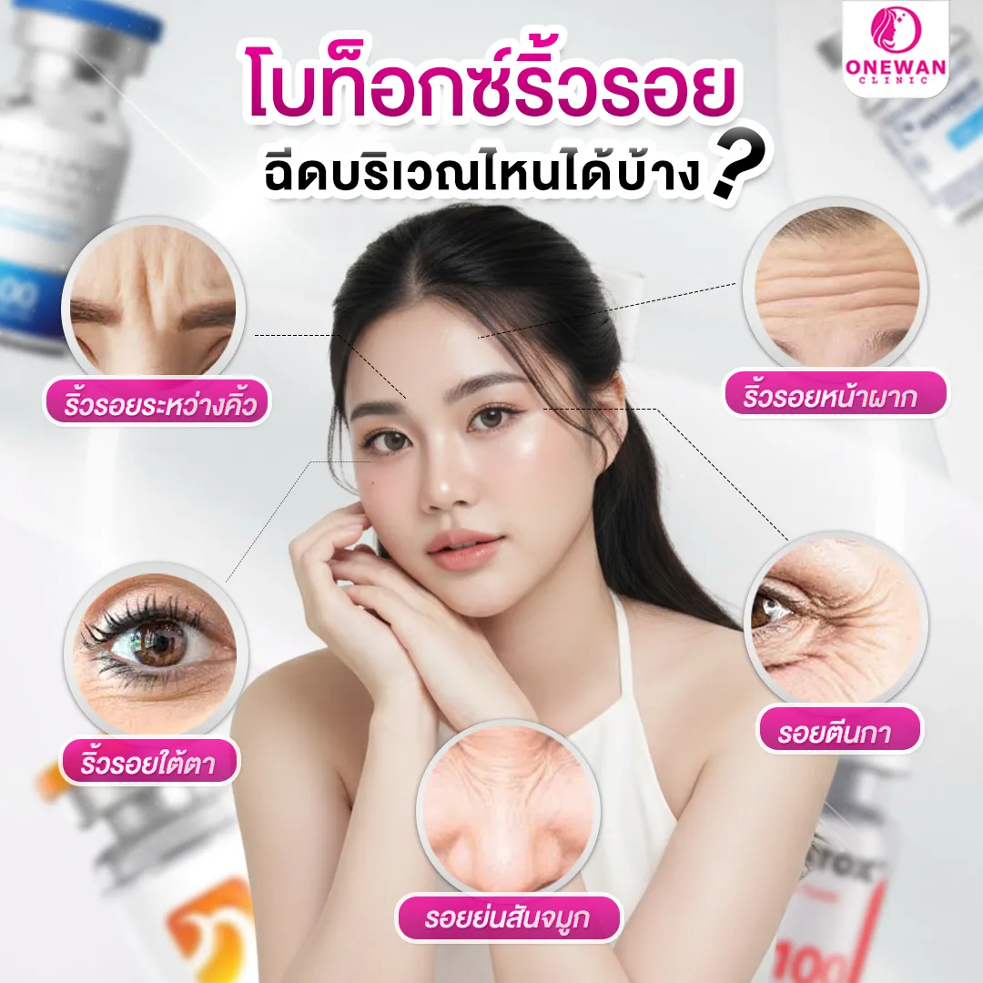 ฉีดโบท็อกลดริ้วรอย จุดไหนได้บ้าง ?