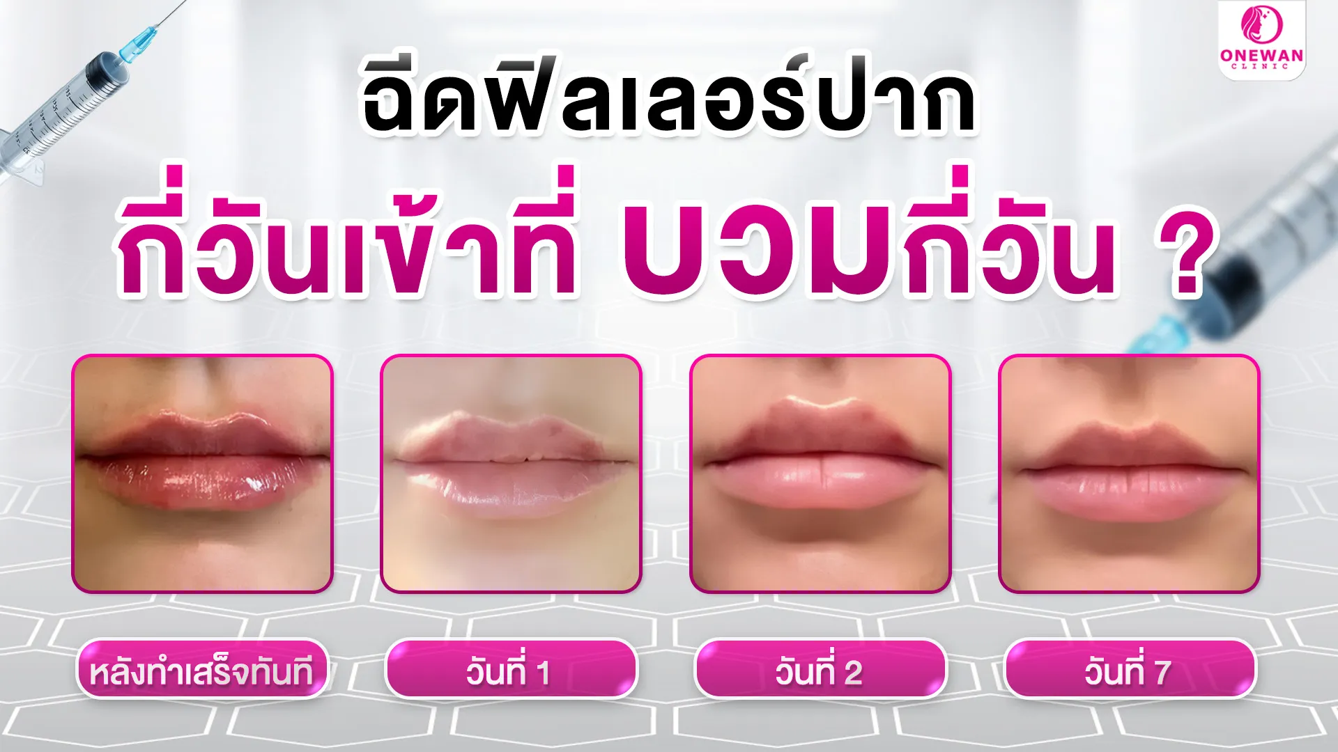 ฉีดฟิลเลอร์ปาก กี่วันเข้าที่ บวมกี่วัน