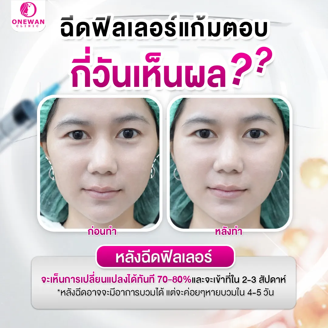 ฉีดฟิลเลอร์แก้มตอบกี่วันเห็นผล