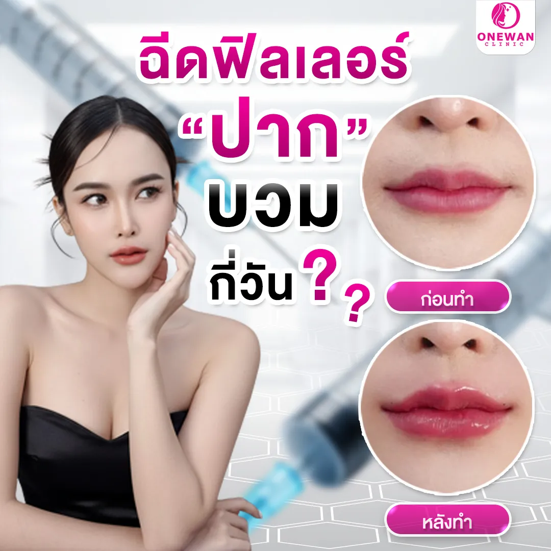 ฉีดฟิลเลอร์ปากบวมกี่วัน