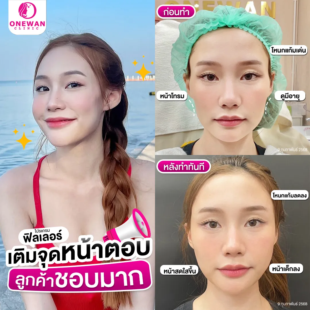 รีวิวฟิลเลอร์แก้มตอบ 1