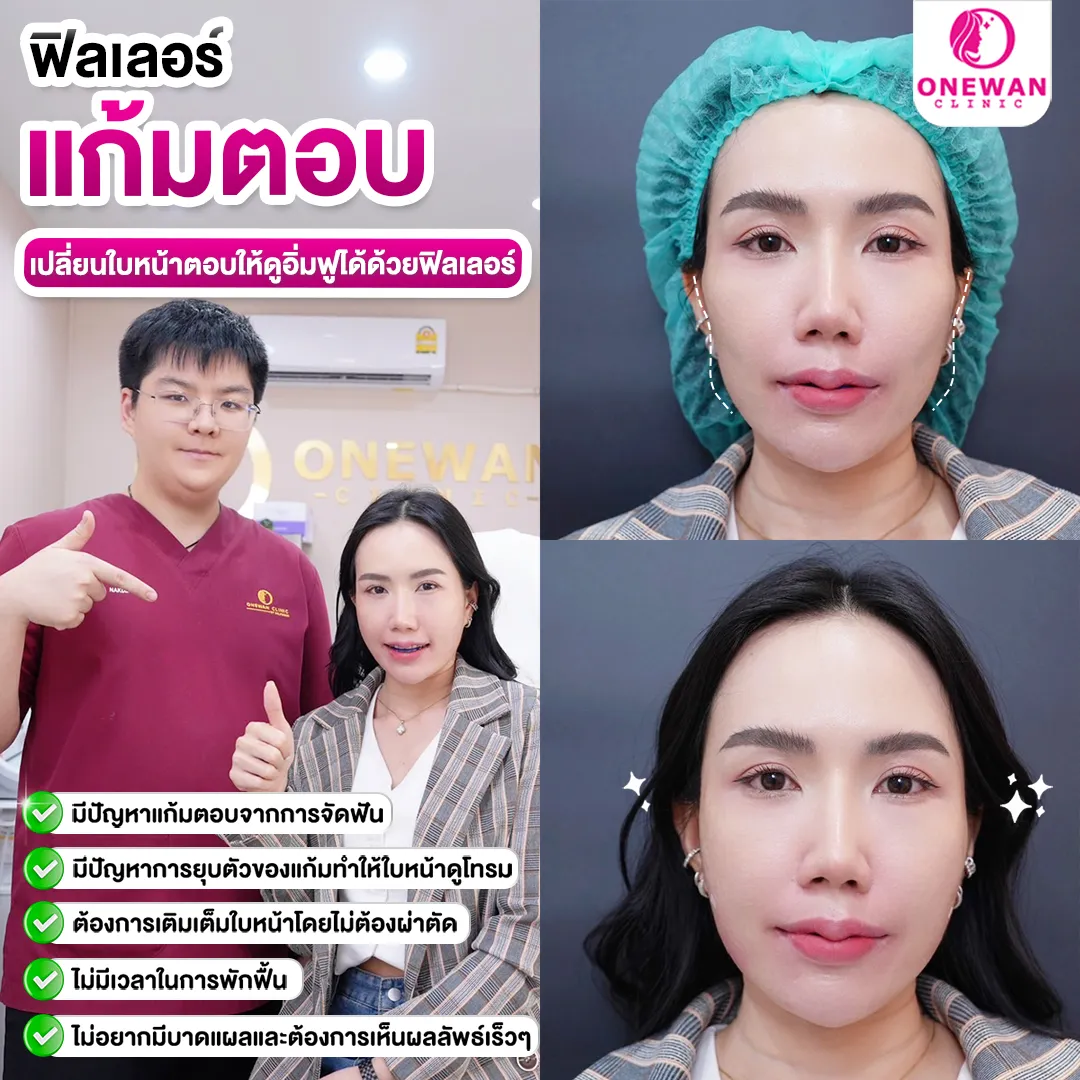 รีวิวฟิลเลอร์แก้มตอบ 2