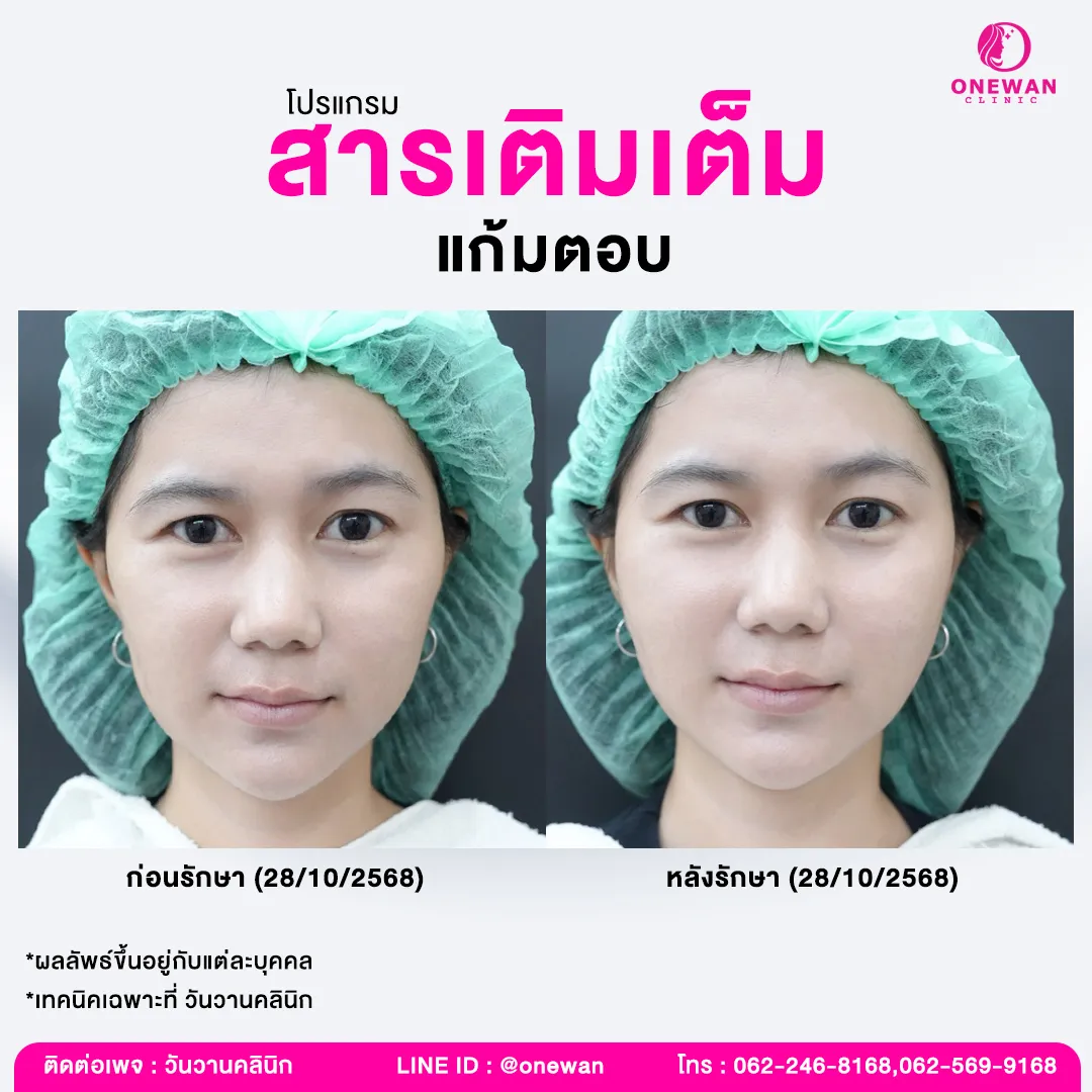 รีวิวฟิลเลอร์แก้มตอบ 3