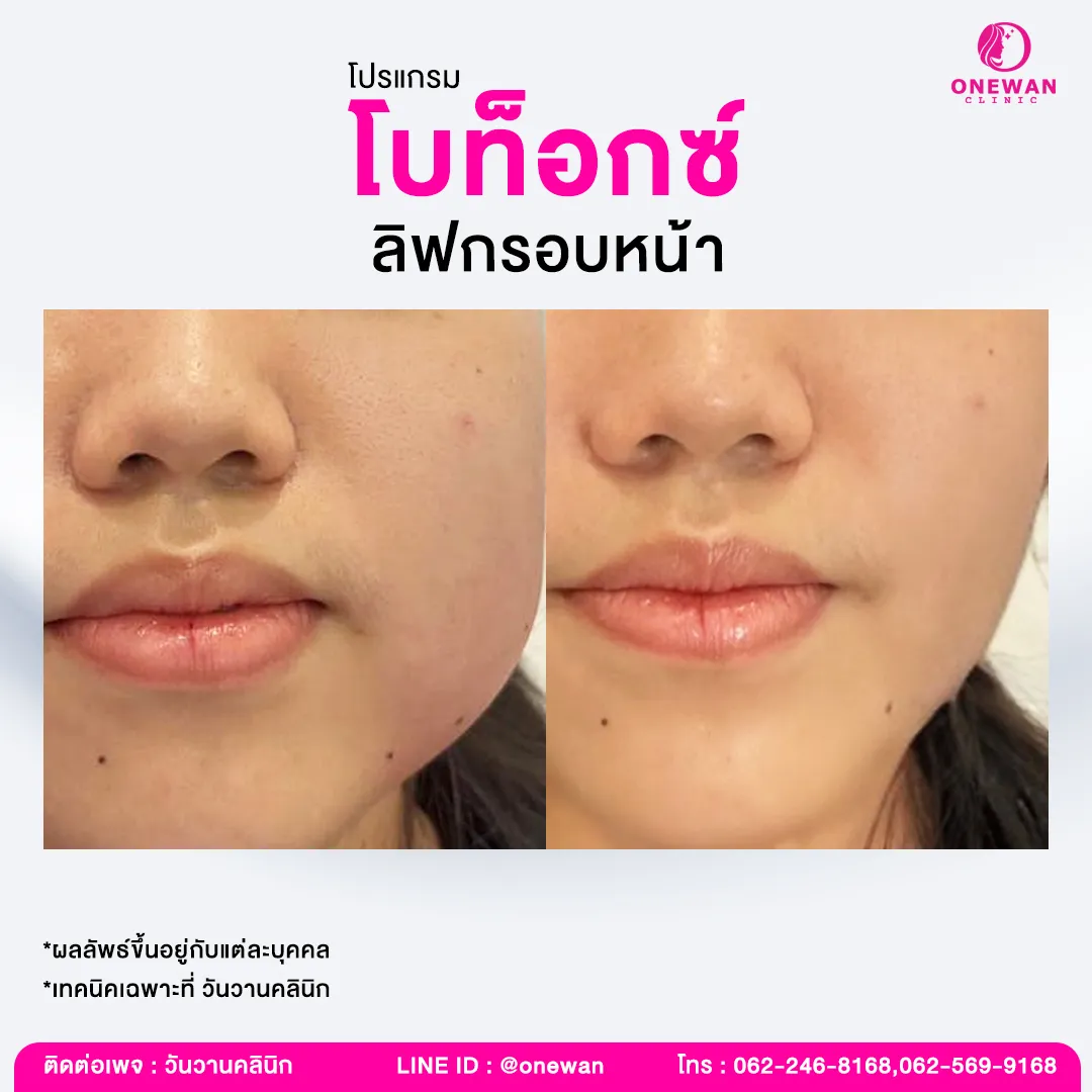 Review of Botox face lifting 1