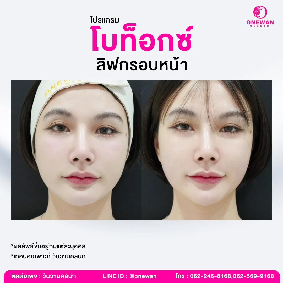 Review of Botox face lifting 2