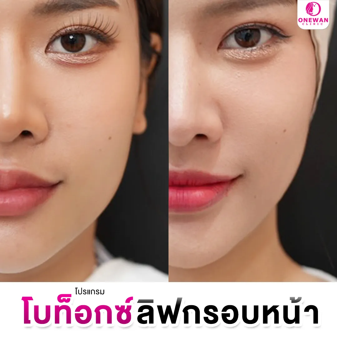 Review of Botox face lifting 3