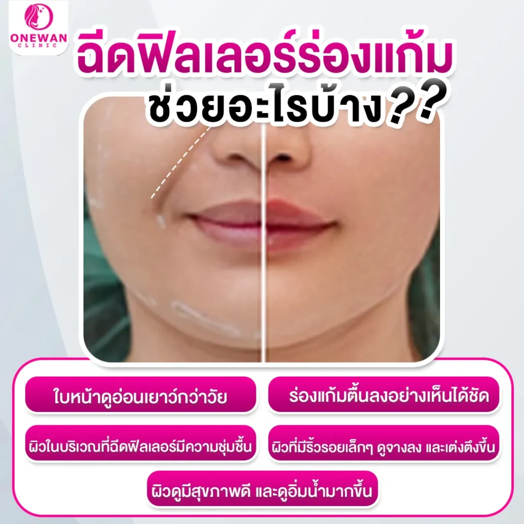 ฉีดฟิลเลอร์ร่องแก้มช่วยอะไรบ้าง