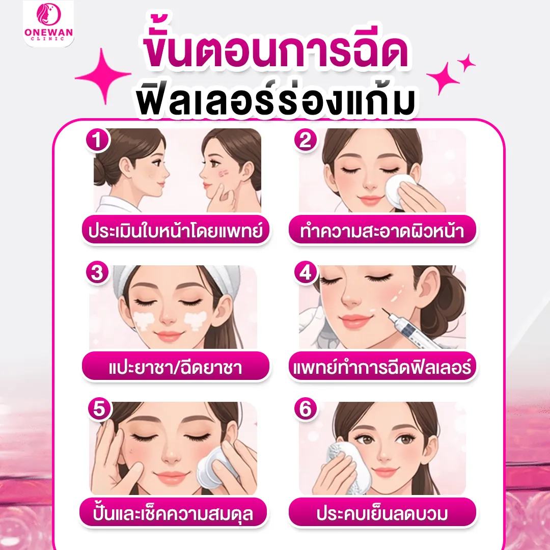 ขั้นตอนการฉีดร่องแก้ม ลดริ้วรอย มีอะไรบ้าง
