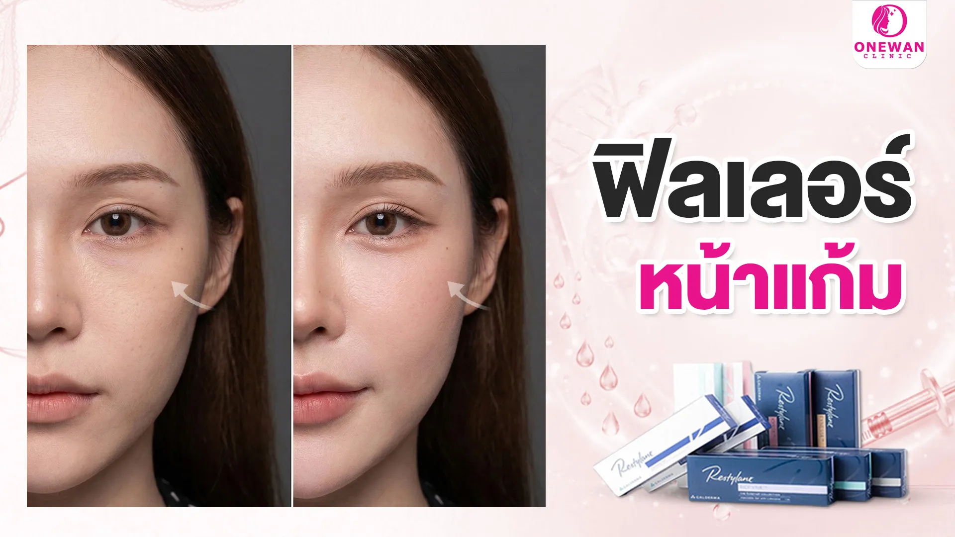 ฟิลเลอร์หน้าแก้มบุรีรัมย์