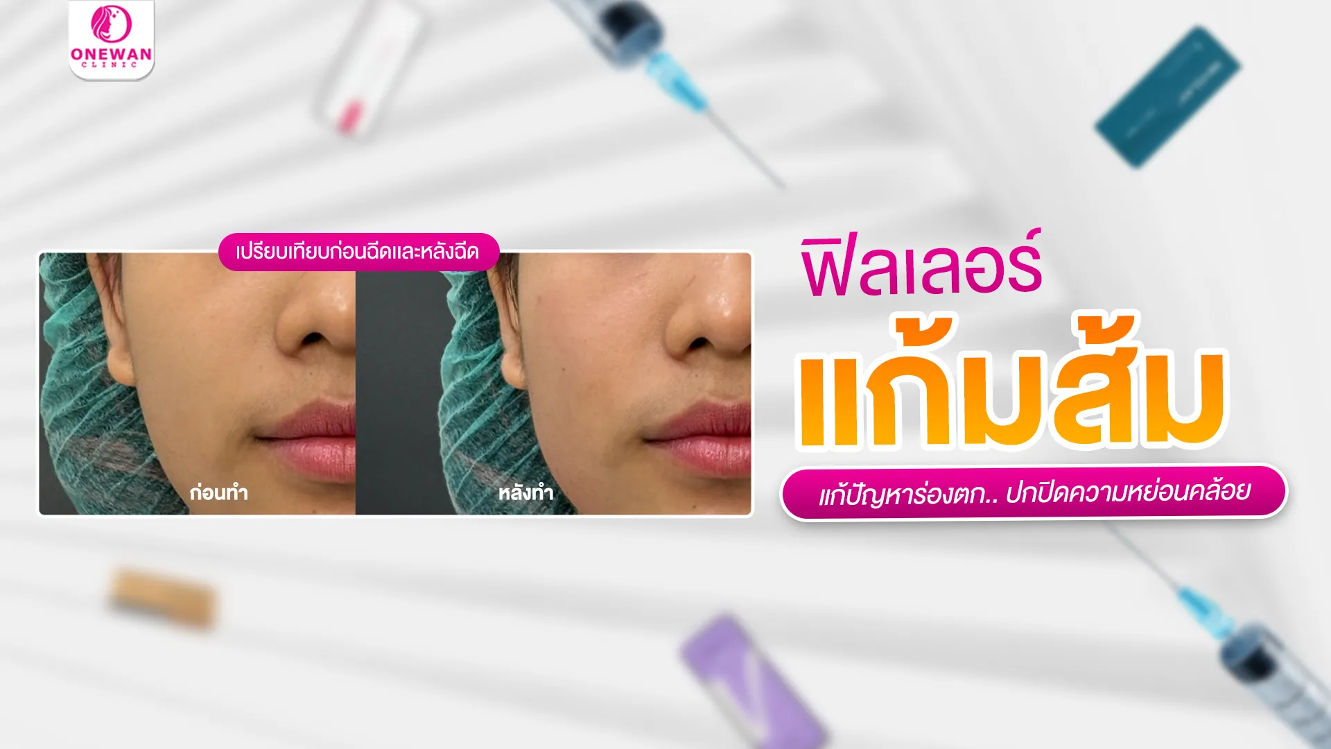 ฉีดฟิลเลอร์แก้มส้ม กี่วันเห็นผล