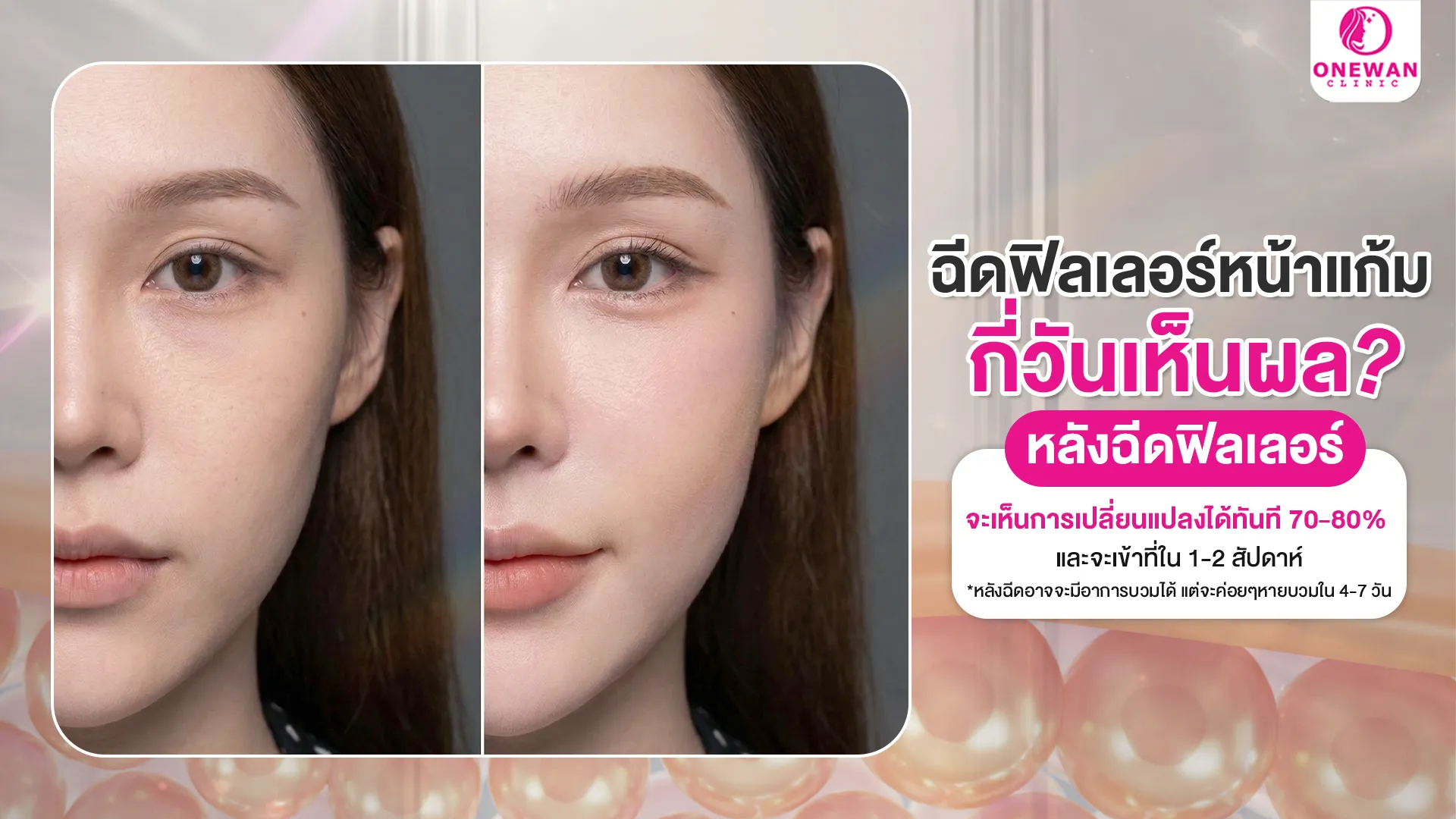 ฉีดฟิลเลอร์หน้าแก้ม เห็นผลกี่วัน