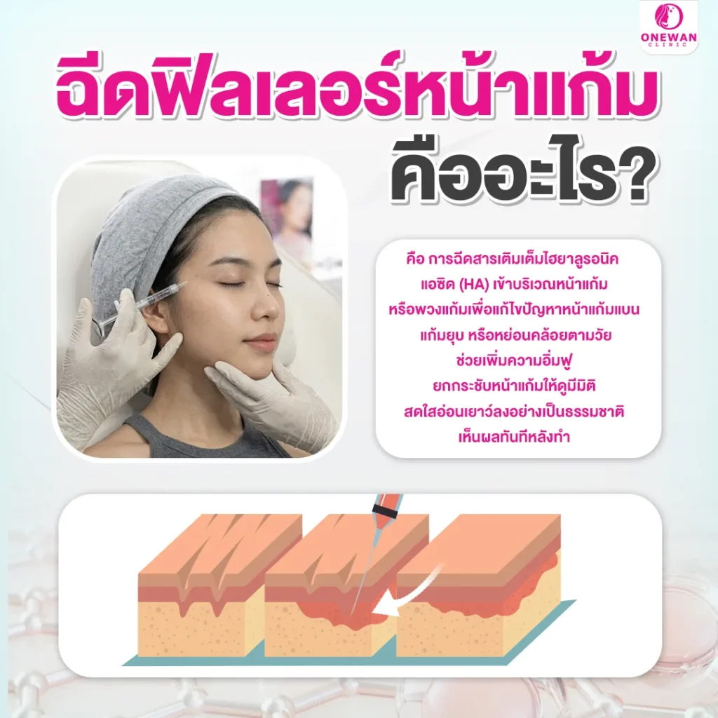 ฟิลเลอร์หน้าแก้ม คืออะไร